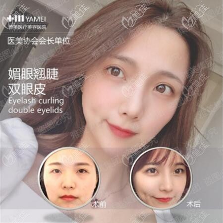 長(zhǎng)沙雅美眼部整形真人案例