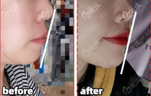 成都牙齒矯正哪家醫(yī)院比較好，先看看我這個齙牙妹戴自鎖托槽牙套的血淚史吧