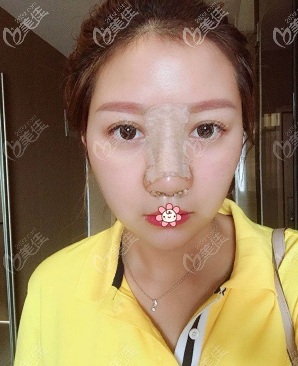 快拆線了 快拆線了