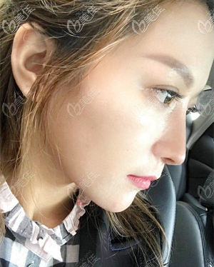 重慶好美畢勝肋軟骨隆鼻術(shù)后半年圖片 重慶好美畢勝肋軟骨隆鼻術(shù)后半年圖片