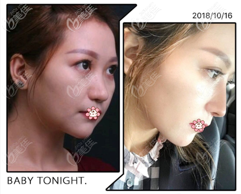重慶好美畢醫(yī)生做鼻子可以，我做的肋軟骨鼻綜合半年后沒(méi)鈣化