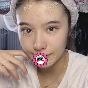 拆線后的雙眼皮效果