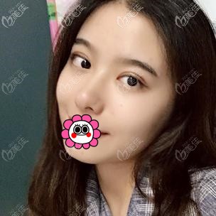 全切雙眼皮術(shù)后恢復(fù)一個月效果