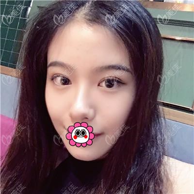 快看我找嘉興藝星張占召做全切雙眼皮恢復(fù)前后對比照，果然做了雙眼皮后的眼睛更好看