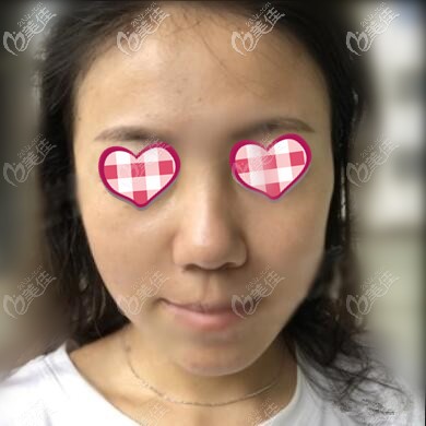 面部年輕化術后第3天效果