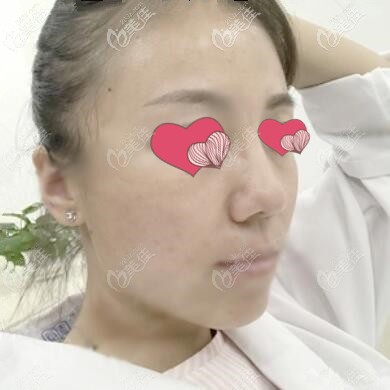 面部提升術后一周效果照