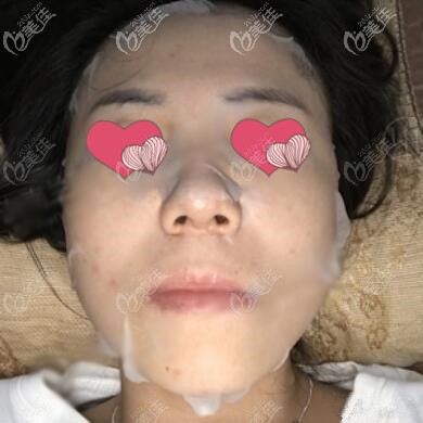 面部埋線提升術后半個月效果照
