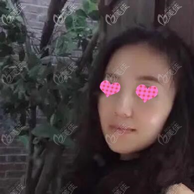 做面部埋線提升術后40天效果照