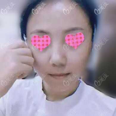 快瞧我找海南蘭顏慧李潤琴做面部埋線提升4個(gè)月了國字臉終于變成小V臉！