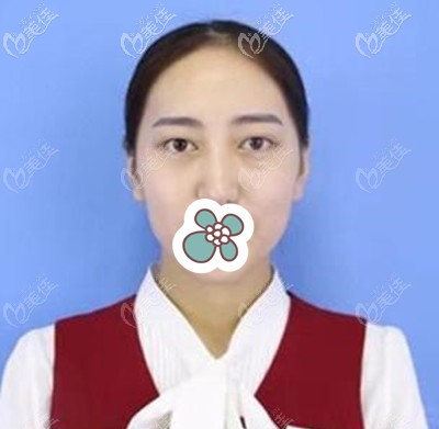 祛眼袋手術(shù)前的我 祛眼袋手術(shù)前的我