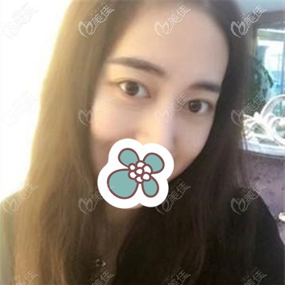 術(shù)后20天的樣子 術(shù)后20天的樣子