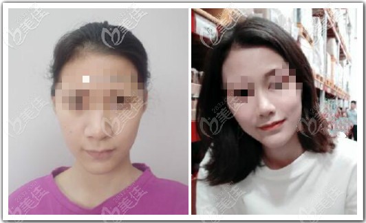 我找昆明吳氏嘉美莊蔚強院長做鼻綜合四項效果對比圖 我找昆明吳氏嘉美莊蔚強院長做鼻綜合四項效果對比圖