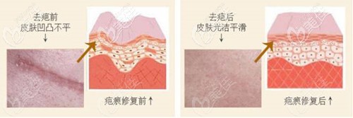 激光祛除乳暈縮小疤痕的示意圖