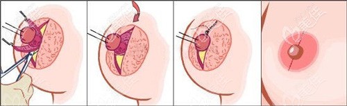 乳暈縮小手術的原理圖