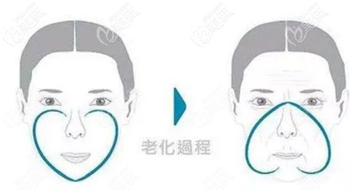 蘋果肌下垂引起法令紋 蘋果肌下垂引起法令紋