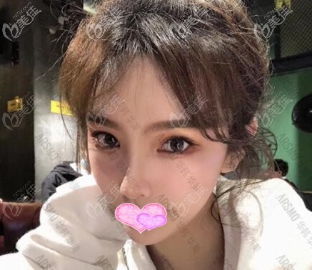 體驗了長沙華韓華美ARSMO潘多拉美眼術(shù)后才知道不僅效果好，而且恢復(fù)也蠻快的！