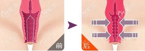 陰道緊縮手術(shù)效果