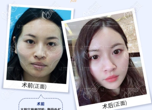 鄭荃做自體脂肪面部填充怎么樣 鄭荃做自體脂肪面部填充怎么樣