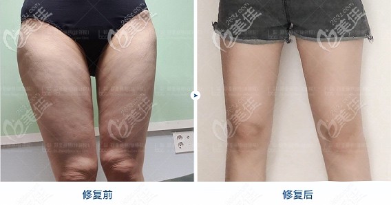 重慶鄭荃麗格大腿吸脂案例 重慶鄭荃麗格大腿吸脂案例