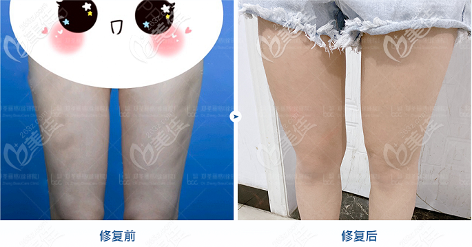重慶大腿吸脂案例圖 重慶大腿吸脂案例圖