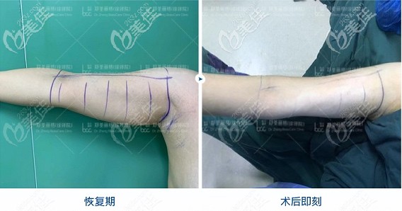 重慶哪家醫(yī)院能做手臂吸脂 重慶哪家醫(yī)院能做手臂吸脂