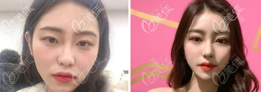 淄博美冠臣醫(yī)療美容醫(yī)院術(shù)前照片1