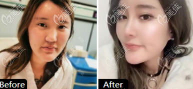 如果你是淄博的妹子不知道如何選隆鼻醫(yī)院，那就來看看這三個案例吧