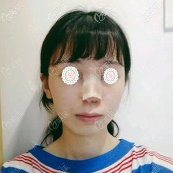 做肋骨鼻的第四天