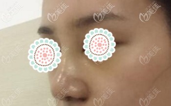 做肋軟骨隆鼻后的一個月