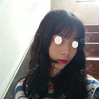 做肋軟骨隆鼻后鼻梁高挺