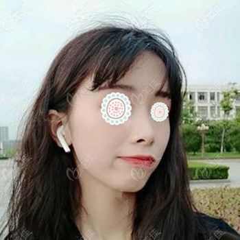 雖然做肋骨鼻后的前3個月恢復(fù)期有點(diǎn)痛苦，但看到術(shù)后效果我覺得不后悔