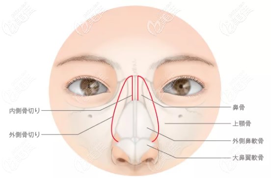 鼻骨內(nèi)推手術(shù)原理 鼻骨內(nèi)推手術(shù)原理
