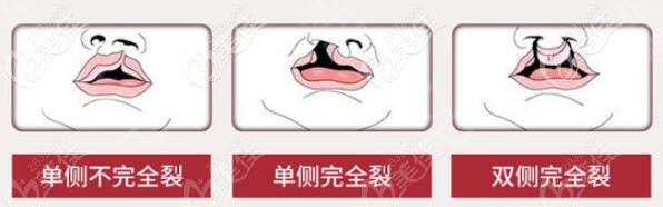 兔唇等級劃分 兔唇等級劃分