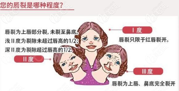 唇裂程度細(xì)分示意圖 唇裂程度細(xì)分示意圖