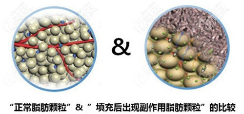 脂肪填充過量脂肪形成硬結(jié)團(tuán)塊示意圖