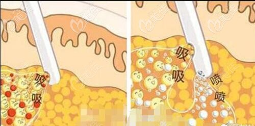 面部吸脂脂肪修復(fù)術(shù)介紹