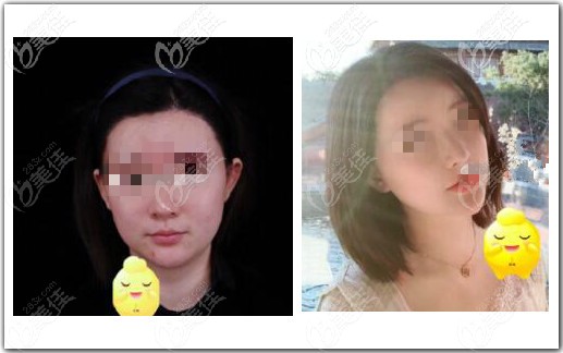 面部吸脂脂肪修復(fù)術(shù)真人案例效果