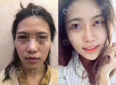 面頰局部脂肪填充過量修復(fù)效果圖