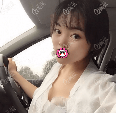 做眼睛好的徐學東醫(yī)生給我做雙眼皮第7天