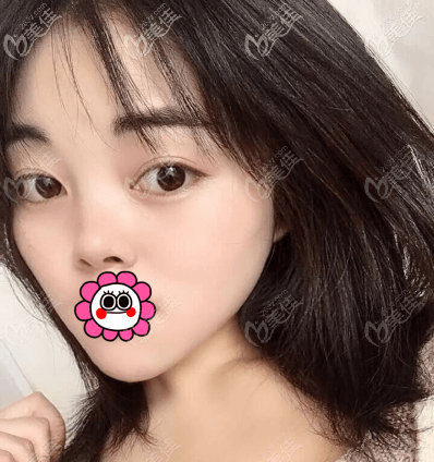 徐學東醫(yī)生在哪家醫(yī)院？得知他在北京畫美醫(yī)院就做了雙眼皮這是45天<span style=