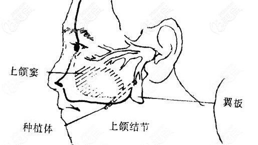 上頜翼板區(qū)種植技術(shù) 上頜翼板區(qū)種植技術(shù)