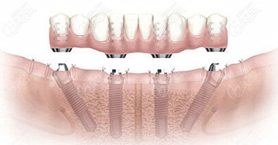All-On-Four半口種植牙技術(shù) All-On-Four半口種植牙技術(shù)