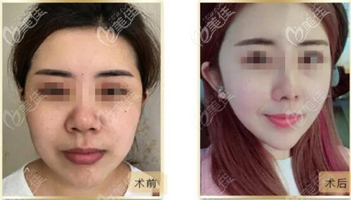 蘭州韓美面部脂肪填充對比案例