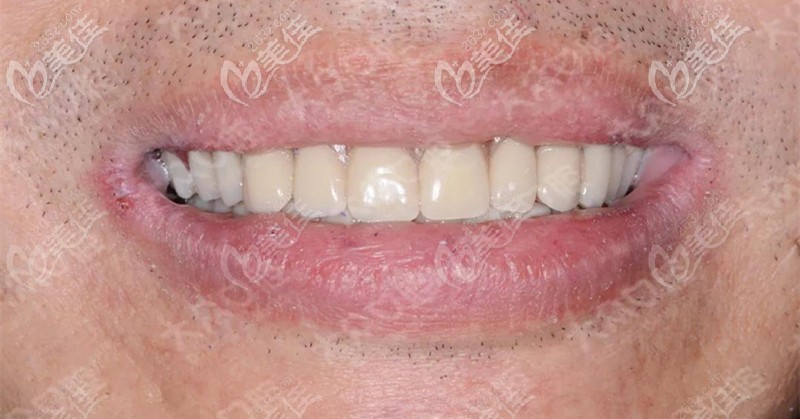 全口戴牙后照片