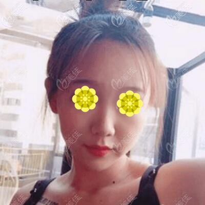 隆鼻術(shù)前照 隆鼻術(shù)前照