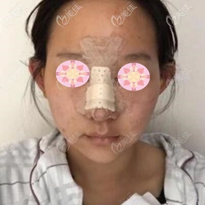 假體隆鼻術(shù)后第2天 假體隆鼻術(shù)后第2天