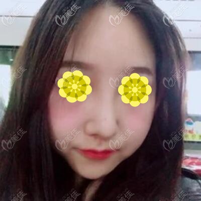 假體隆鼻半個(gè)月恢復(fù)照 假體隆鼻半個(gè)月恢復(fù)照