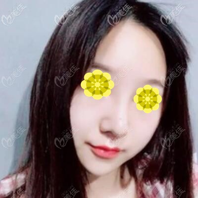 假體隆鼻1個(gè)月時(shí)的效果照 假體隆鼻1個(gè)月時(shí)的效果照