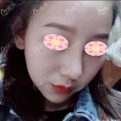 做假體隆鼻2個(gè)月時(shí)的效果照 做假體隆鼻2個(gè)月時(shí)的效果照