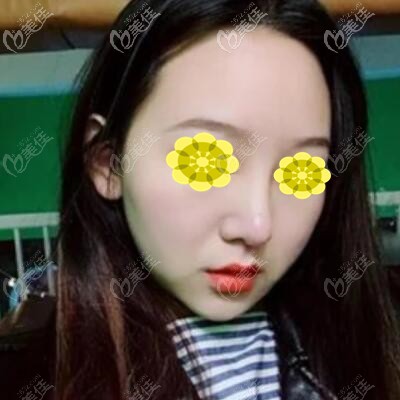 長沙美萊潘衛(wèi)峰硅膠假體隆鼻真人案例：3個多月從塌鼻子到高挺鼻怎么看怎么美！